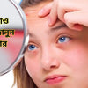 কপালে ব্রণ? ৭ দিনেই ব্রণ উধাও করতে জানুন প্রতিকার!