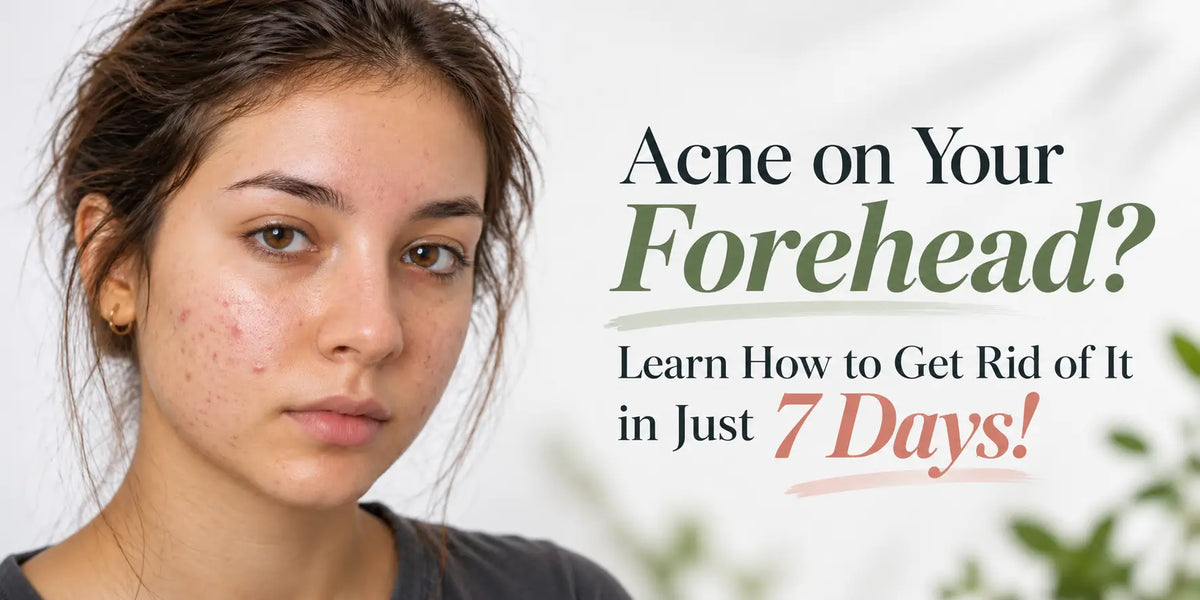 Acne on Your Forehead? Learn How to Get Rid of It in Just 7 Days!
