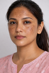 Melasma