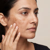 Melasma